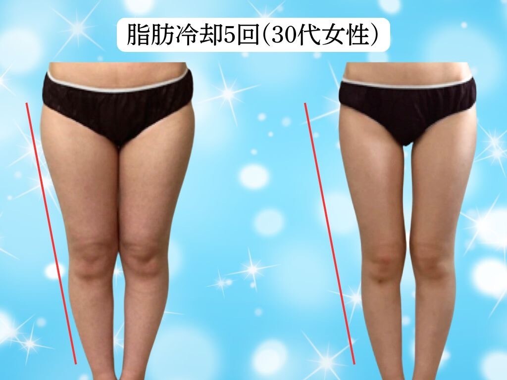 ラジオ波 痩身 新宿に関するサロン 二の腕・美肌・ブライダル Queen's