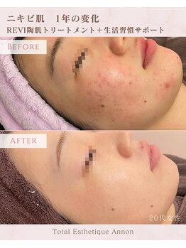 アンノン(Annon)/陶肌トリートメント症例