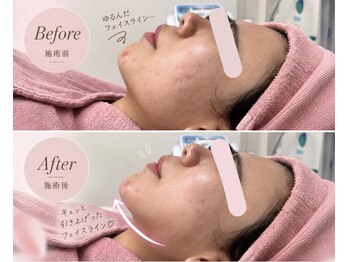 エン クリニカルラボ 心斎橋店(E&N CLINICAL LABO)の写真/小顔・リフトアップ機器多数！韓国アイドルも受けてるうる艶"LDM"引き締め×美肌を一気に解決☆サーマ