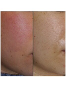 トラット エステアンドアイズ(tratto)/30代　お客様症例写真