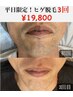 【平日限定】抜ける！ヒゲ脱毛3回　¥19,800（顔全体＋首込）洗顔パック付☆