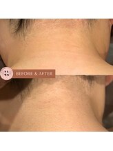 トレテル/女性全身脱毛うなじ