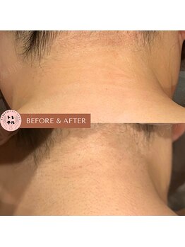 トレテル/女性全身脱毛うなじ