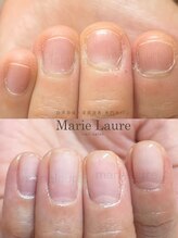 マリーロール 梅田店(Marie Laure)/深爪矯正/自爪育成/自爪風
