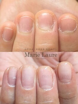 マリーロール 梅田店(Marie Laure)/深爪矯正/自爪育成/自爪風