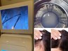 頭皮のお悩みはこちら！頭皮洗浄+ヒト幹細胞導入