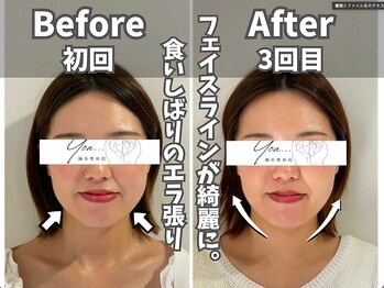 鍼灸整体院ユー(鍼灸整体院You...)/美容鍼×小顔矯正　施術後の変化