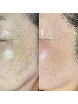 ポルテ(porte)/40代 光沢フォト6回