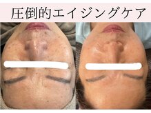 細胞美容★エイジングケアを叶えるハーブピーリング★フォト★