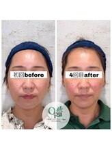 キュープ 相模原淵野辺店(Qpu)/たった4回で人生で1番小さな顔に