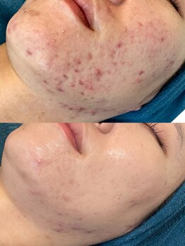 ソリッジ肌管理室/ニキビケアならソリッジ肌管理室