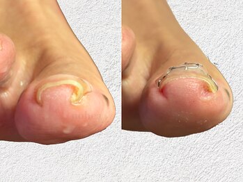 ルーム ノヘア(Room nohea)/【フットケア】巻き爪矯正 2