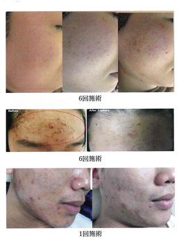 ビューティースペース 品川大井町店(Beauty Space)/プラズマフェイシャル