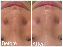 サロンドフェイス(Salon de Faith)/ハーブピーリング2回