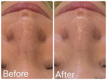 サロンドフェイス(Salon de Faith)/ハーブピーリング2回