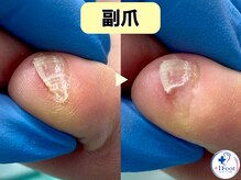 プラスワンフット 本厚木(+1 Foot)/痛い・引っかかる・邪魔な副爪に