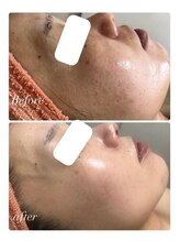 オアジスパ(Oasi Spa)/バイオセルショット65　１クール