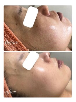 オアジスパ(Oasi Spa)/バイオセルショット65　１クール