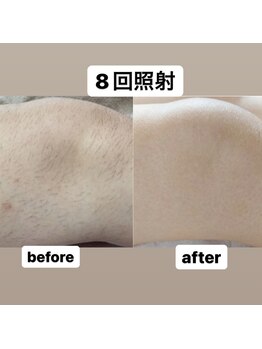 ココ(Coco)/全身脱毛・メンズ脱毛