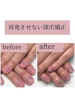 ティアラネイル(tiaranail)/再発させない深爪矯正