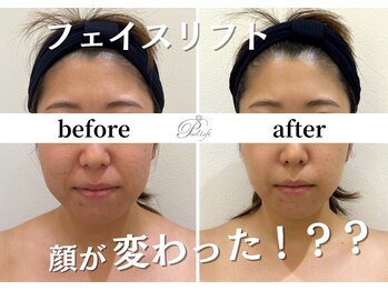 パールリフト 小田原店/顔が変わったレベルの小顔