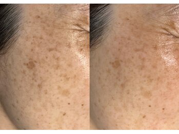 モガナ(mogana)/50代・ぱっと輝くお肌！