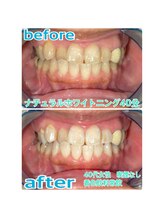 プラチナムビューティー 川口駅前店(PLATINUM BEAUTY)/初回40分の症例写真