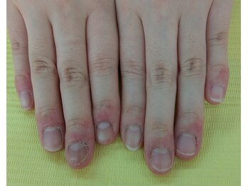 ネイルサロンひまわり/【深爪矯正・1】施術前の状態