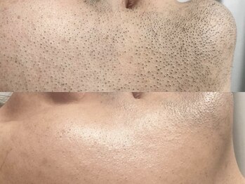 エミュ(emu formen)/髭脱毛が与える印象