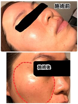 美肌屋よもぎ庵/シミケア×よもぎ蒸し