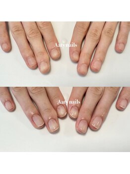 アーティネイルズ(Aaty Nails)/深爪が再発しないプログラム
