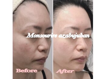 モンスリール 麻布十番(Mon Sourire)/歯髄幹細胞生100%フェイシャル