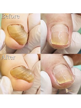 巻き爪補正店 湘南辻堂店/分厚い爪・変形爪の再生補正