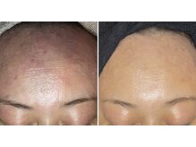 アイスリー(i III)/お顔全体もケア