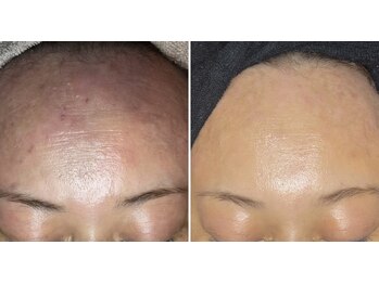 アイスリー(i III)/お顔全体もケア