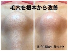 ピエル 北千住店(PIEL)/毛穴を根本から改善