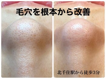 ピエル 北千住店(PIEL)/毛穴を根本から改善