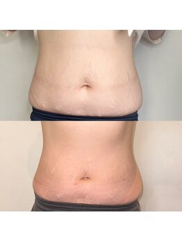 プルメリア(Plumeria)/マグニート1クール終了間際1