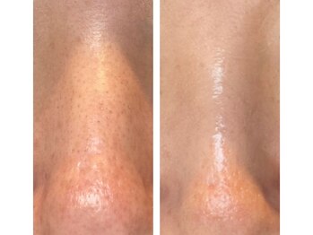 ミュー(professional beauty salon MYU)/フェイシャルエステ/毛穴洗浄