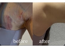 ミカド 銀座(mikado)/二の腕吸引/ビフォーアフター