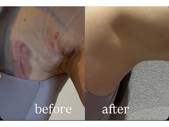 ミカド 銀座(mikado)/二の腕吸引/ビフォーアフター