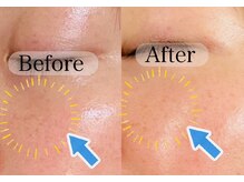 アンシャンテ(Anchant)/【ダクトピール（水光肌）】