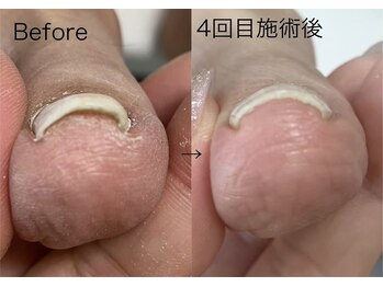 ロンディネ(Rondine)/巻き爪ケア&ネイルトリム26