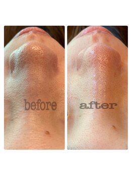 エミナル(Eminal)/◇毛穴エクストラクションtete式