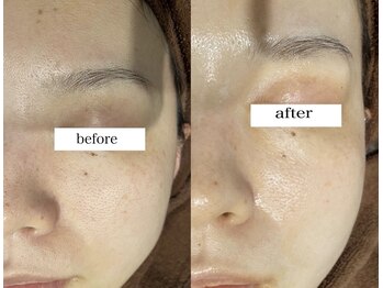 フルール(Fleur)/◆毛穴レス/肌管理/毛穴洗浄◆