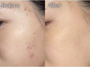 ヨハク 市川店(yohaku)/ハーブピーリング