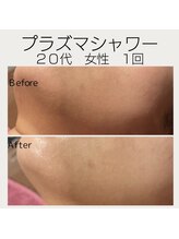 ビトタン 倉敷本店(+美to鍛)/新メニュー！プラズマシャワー