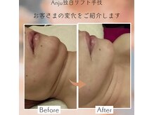 アンジュ(Anju)の雰囲気（プラチナリフト70分後のお写真です。輪郭美と透明感のダブルUP）