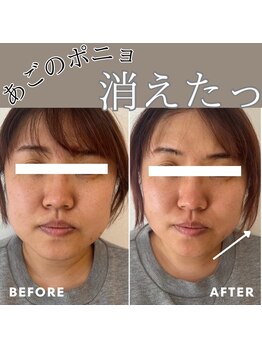 マヴィ くずは店(MavY.)/人気No.2水光注入x筋膜