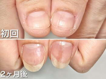 グラシュータン(gracieux temps)/【深爪矯正13000円】